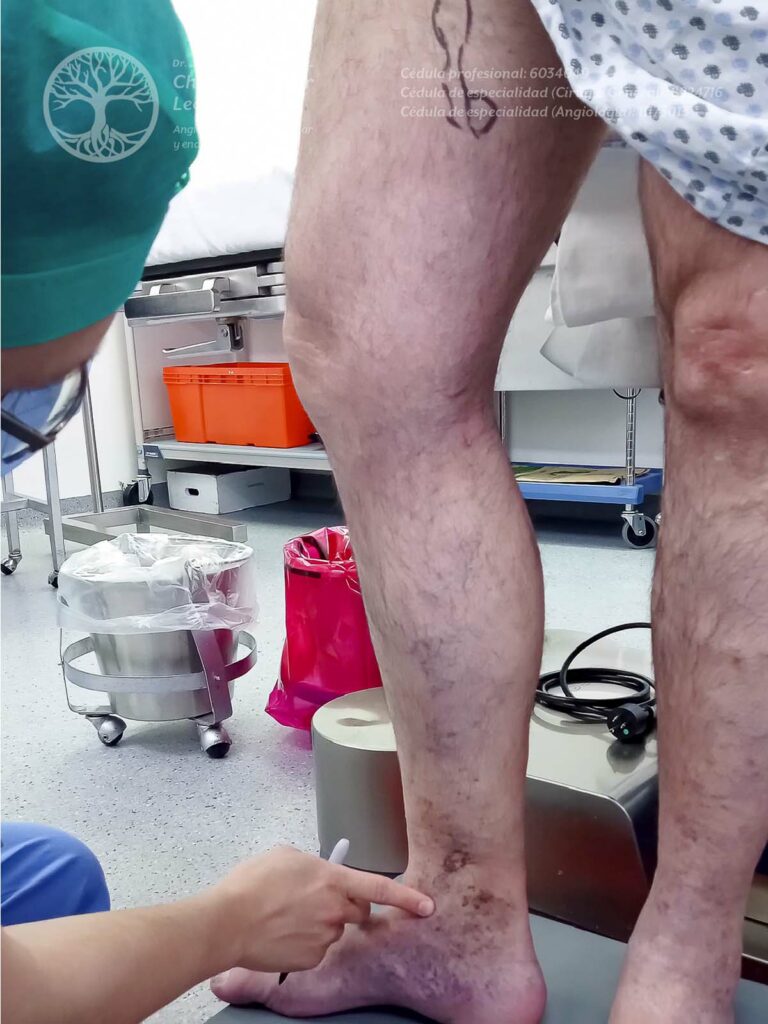 Preparación del área a tratar