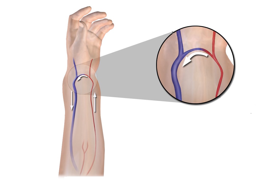 Fístula arteriovenosa