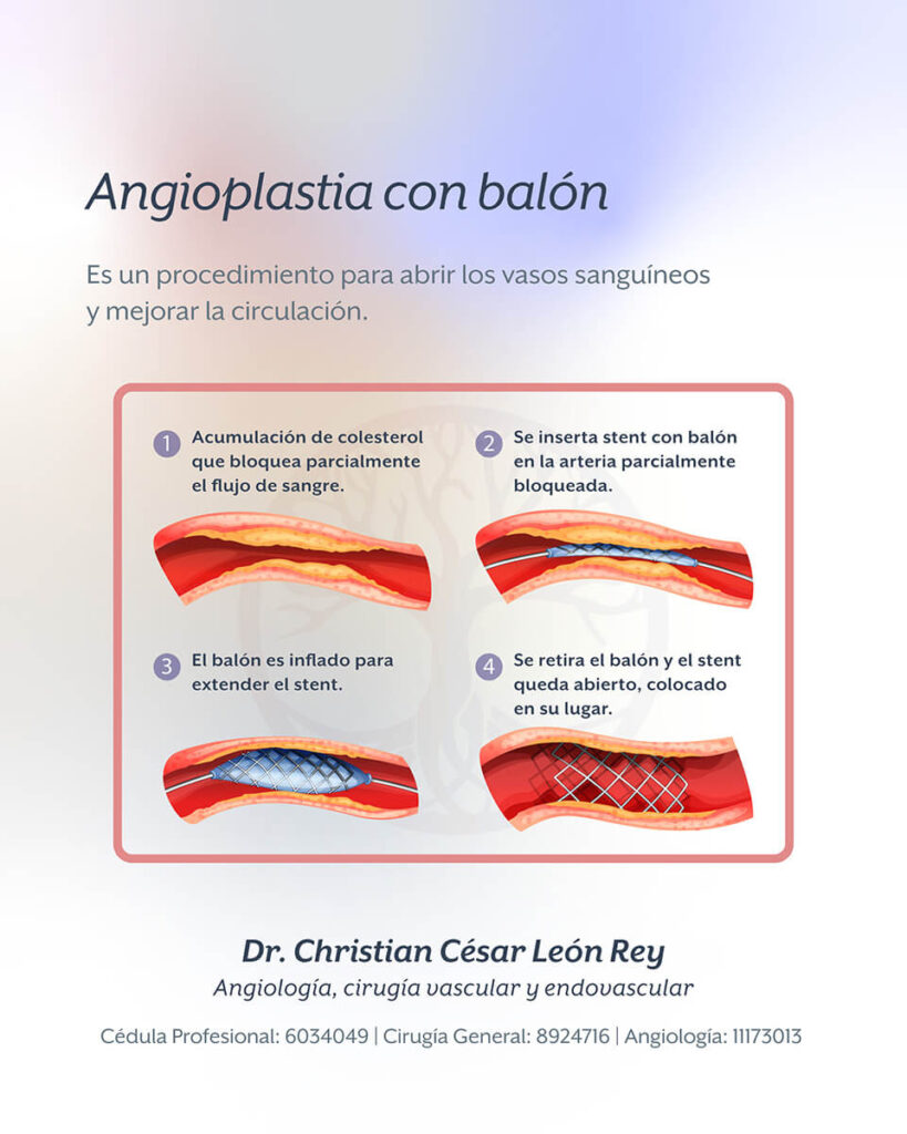 Angioplastia con balón