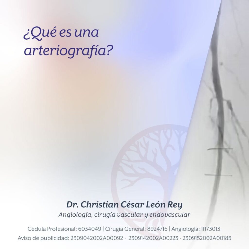 ¿Qué es una arteriografía?